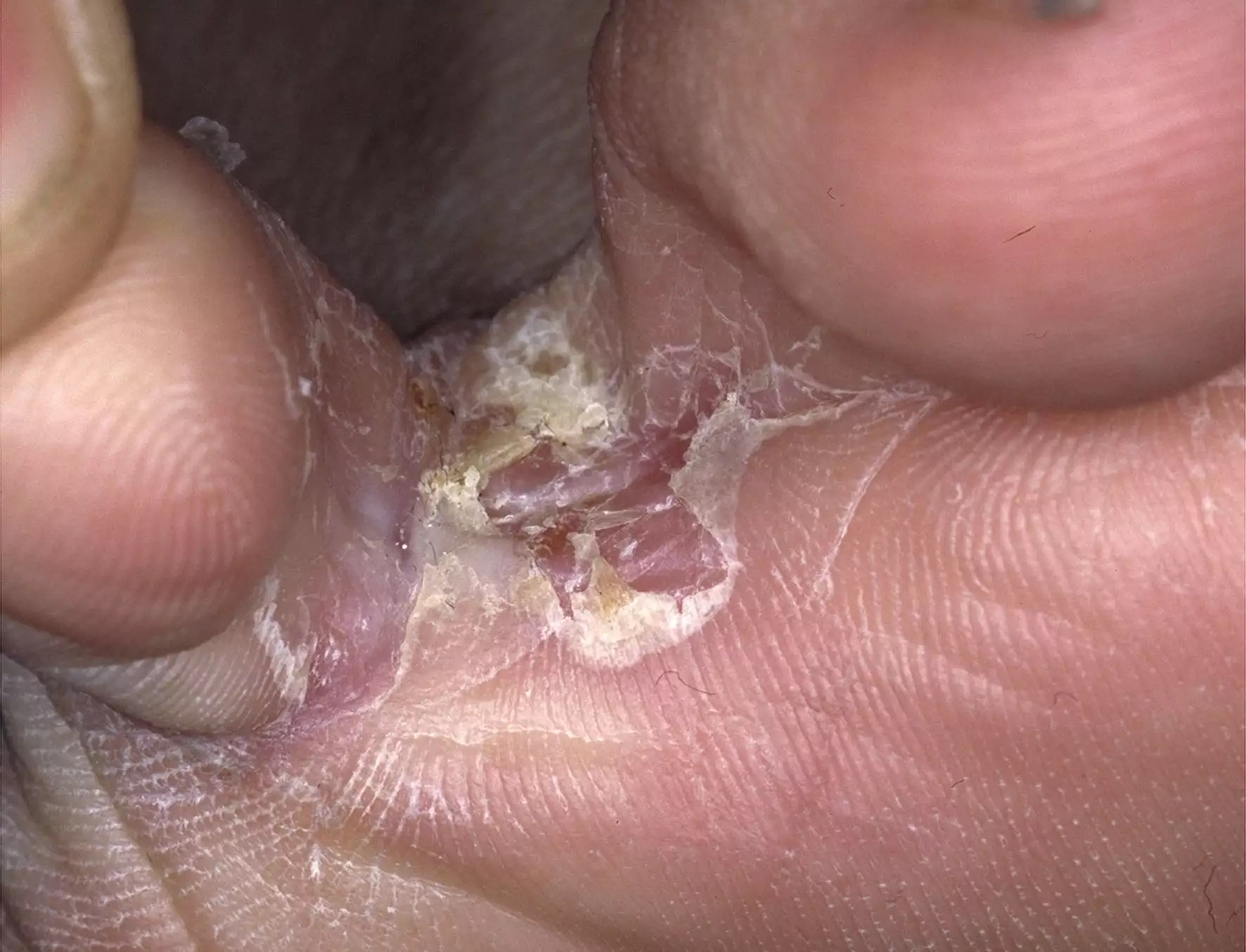 10 Home Remedies for Athlete’s Foot (1)